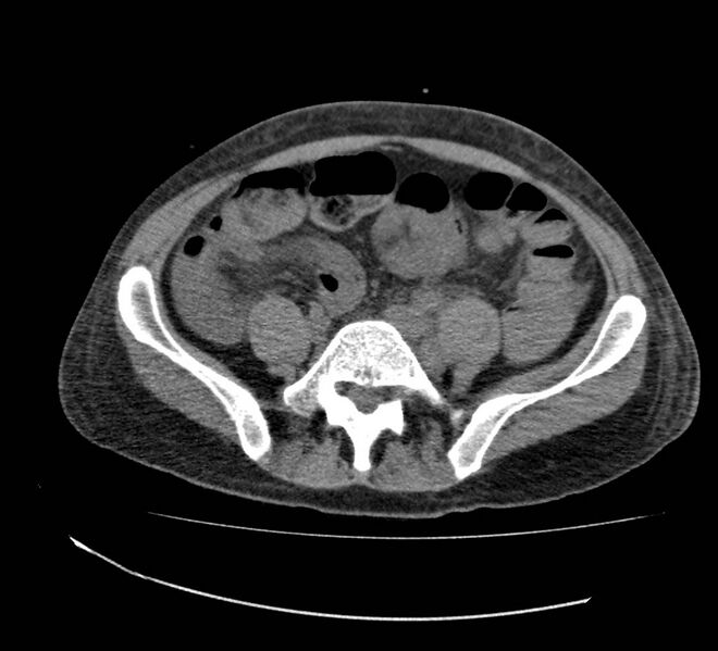 File:Bowel lymphoma complicated by bleeding after therapy (Radiopaedia 55601-62110 Axial non-contrast 57).jpg