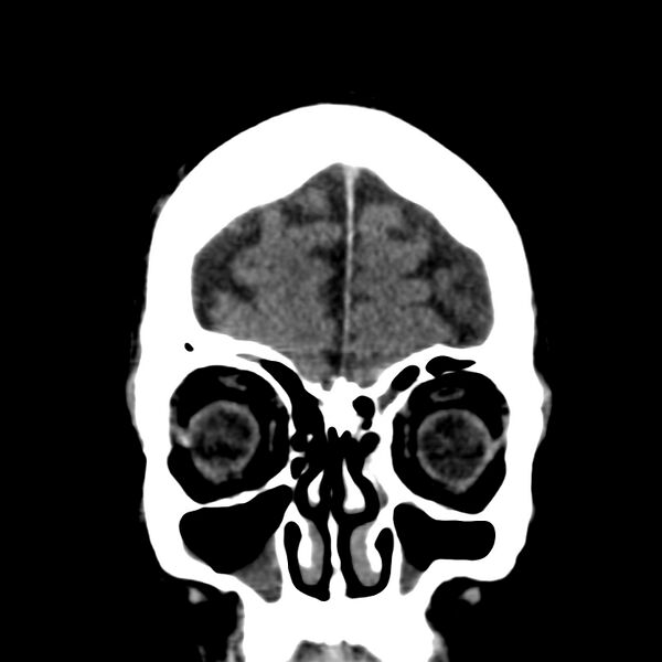 File:Brain Pantopaque remnants (Radiopaedia 78403-91048 Coronal non-contrast 12).jpg