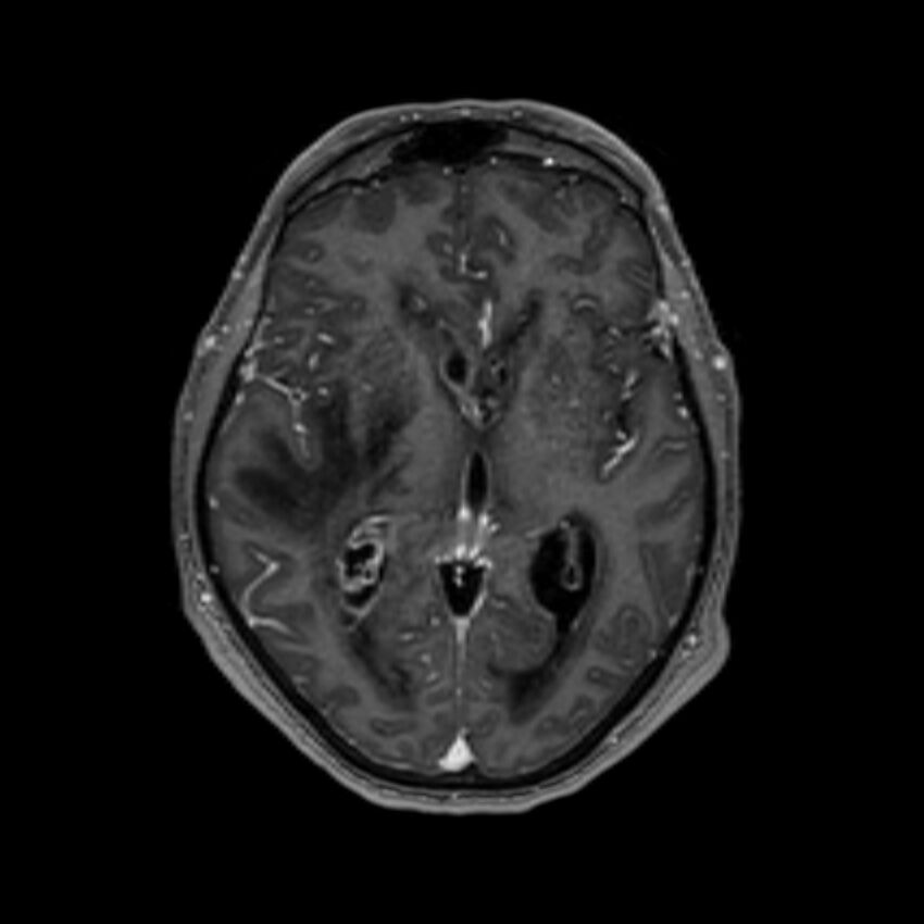 Brain abscess complicated by intraventricular rupture and ventriculitis (Radiopaedia 82434-96577 Axial T1 C+ 33).jpg