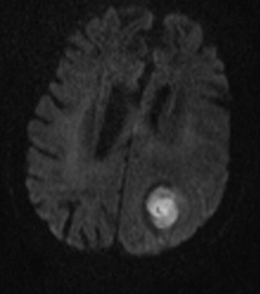 File:Brain abscess with dual rim sign (Radiopaedia 87566-103938 Axial DWI 13).jpg