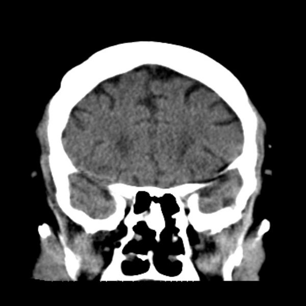 File:Brain cortical laminar necrosis (Radiopaedia 25822-25971 C 17).jpg