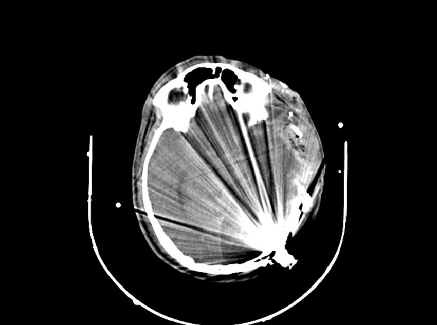 Brain injury by firearm projectile (Radiopaedia 82068-96087 B 95).jpg