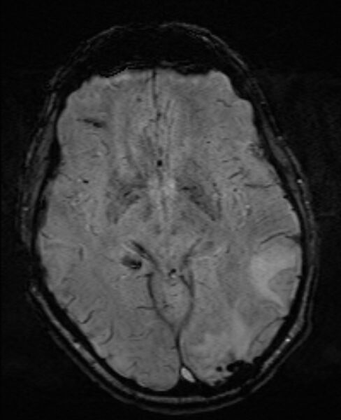 File:Brain metastases - lung cancer primary (Radiopaedia 75060-86115 Axial SWI 29).jpg