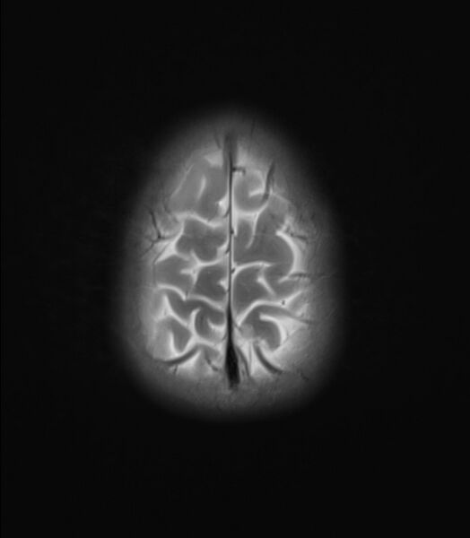 File:Brainstem glioma (Radiopaedia 70548-80674 Axial T2 23).jpg