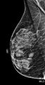 Breast hamartoma (Radiopaedia 89472-106453 MLO 1).jpg