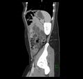 Broad ligament hernia (Radiopaedia 63260-71832 C 42).jpg