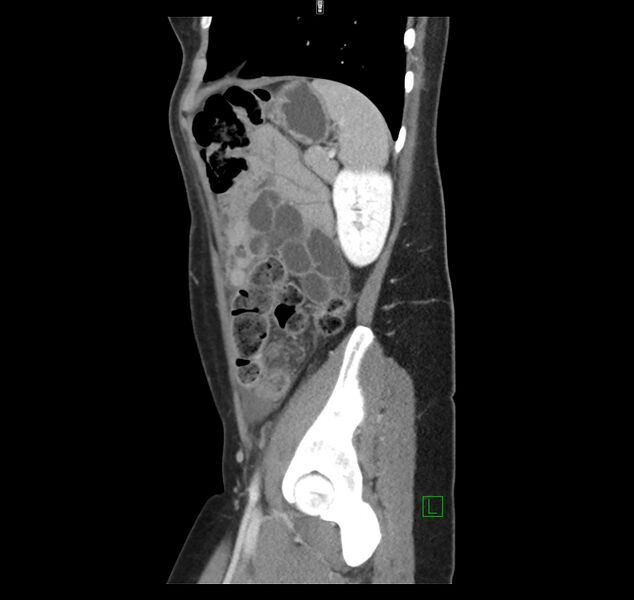 File:Broad ligament hernia (Radiopaedia 63260-71832 C 42).jpg