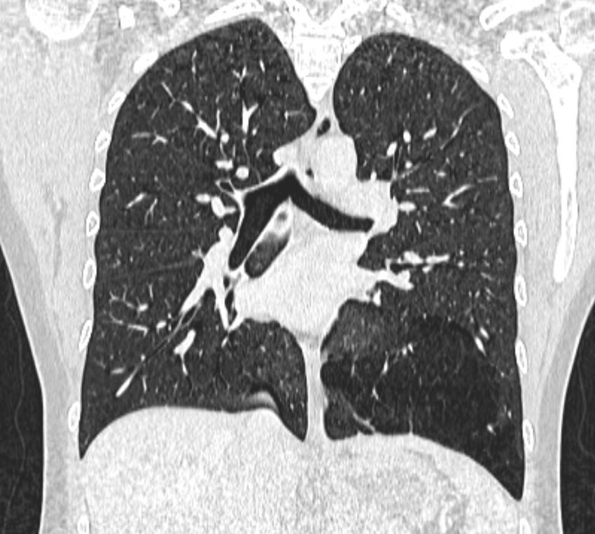 Bronchial atresia (Radiopaedia 50007-55297 Coronal lung window 60).jpg