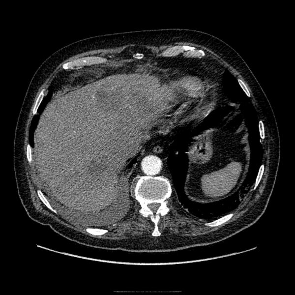 File:Bronchogenic adenocarcinoma and pulmonary embolism (Radiopaedia 9097-9806 D 50).jpg