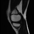 Bucket handle tear - lateral meniscus (Radiopaedia 72124-82634 Sagittal T2 13).jpg