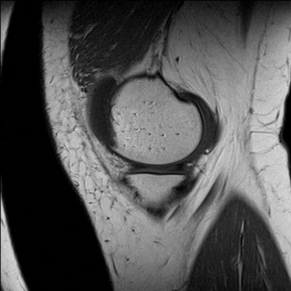 File:Bucket handle tear - medial meniscus (Radiopaedia 79028-91942 Sagittal T1 21).jpg