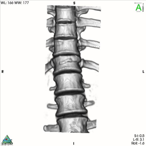 File:Bulging of paraspinal line in traumatic thoracal spinal compression fracture (Radiopaedia 29221-35872 3D VR 11).jpg