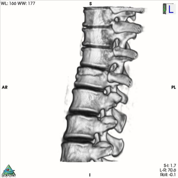 File:Bulging of paraspinal line in traumatic thoracal spinal compression fracture (Radiopaedia 29221-35872 3D VR 20).jpg