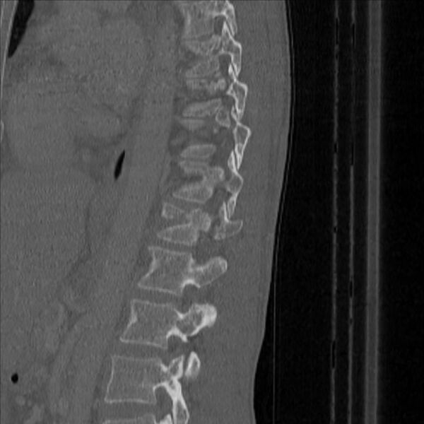 File:Bulging of paraspinal line in traumatic thoracal spinal compression fracture (Radiopaedia 29221-35872 Sagittal bone window 41).jpg