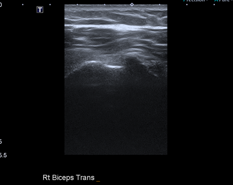 File:Calcific tendinitis (ruptured) (Radiopaedia 56393-63053 A 1).png