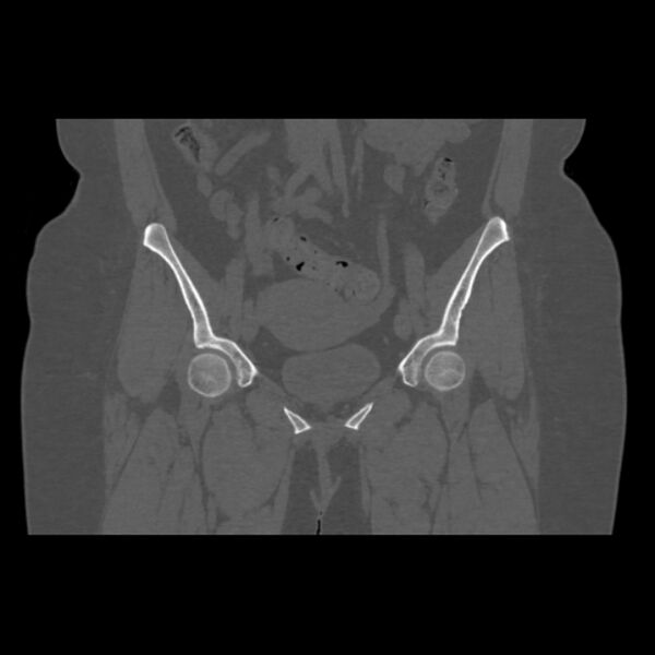 File:Calcific tendinitis of the gluteus medius muscle (Radiopaedia 66998-76318 Coronal bone window 22).jpg