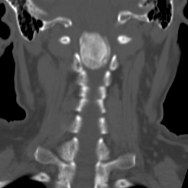 File:Calcified meningioma - cervical canal (Radiopaedia 70136-80171 Coronal bone window 19).jpg