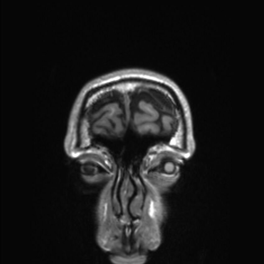 Callosal dysgenesis with interhemispheric cyst (Radiopaedia 53355-59335 Coronal T1 181).jpg
