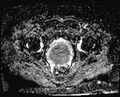 Cancer cervix - stage IIb (Radiopaedia 75411-86615 Axial ADC 10).jpg