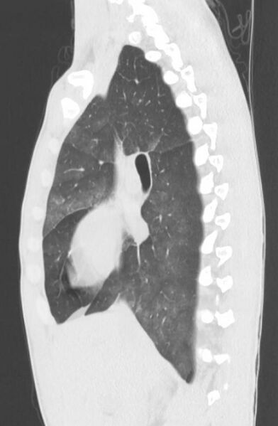 File:Cannabis-induced diffuse alveolar hemorrhage (Radiopaedia 89834-106946 Sagittal lung window 57).jpg