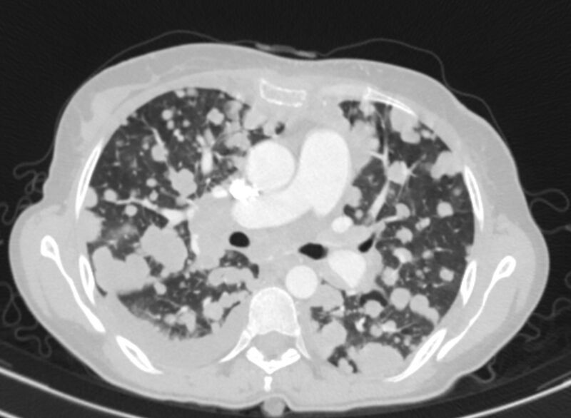 File:Cannonball metastases from breast cancer (Radiopaedia 91024-108569 Axial lung window 41).jpg