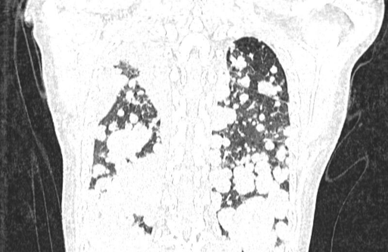 File:Cannonball metastases from breast cancer (Radiopaedia 91024-108569 Coronal lung window 122).jpg