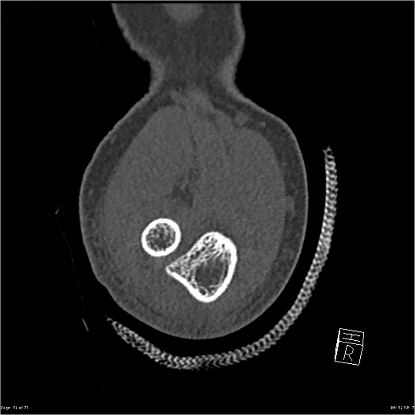 Capitellum fracture (Radiopaedia 23352-23426 Coronal bone window 51).jpg