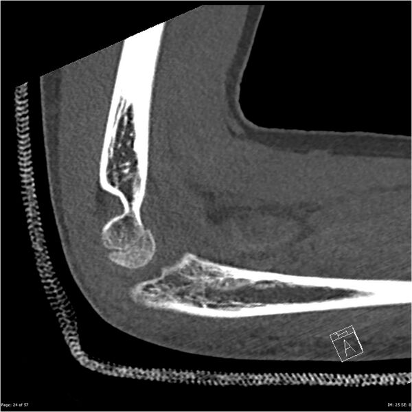File:Capitellum fracture (Radiopaedia 23352-23426 Sagittal bone window 24).jpg