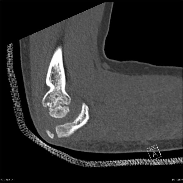 File:Capitellum fracture (Radiopaedia 23352-23426 Sagittal bone window 40).jpg