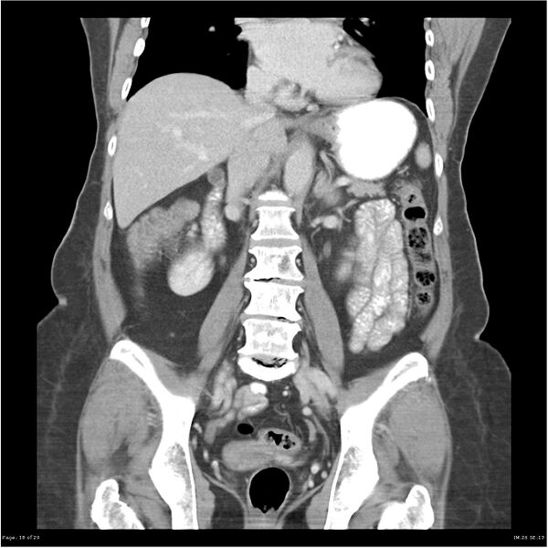 File:Carcinoid tumor of the ileum with metastasis to orbit (Radiopaedia 28165-28425 B 18).jpg