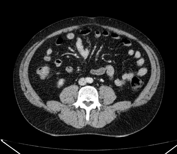 File:Carcinoid tumor with hepatic metastases (Radiopaedia 22651-22670 C 55).jpg