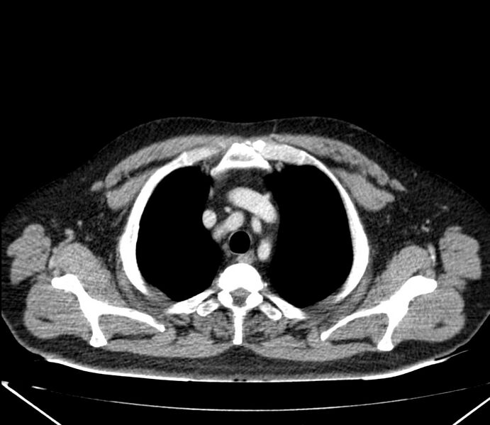 File:Carcinoid tumor with hepatic metastases (Radiopaedia 22651-22670 C 6).jpg