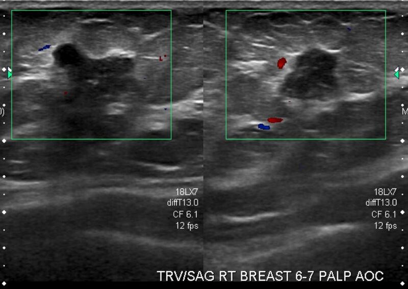 File:Carcinoma right breast - value of tomosynthesis (Radiopaedia 37989-39936 A 1).JPG