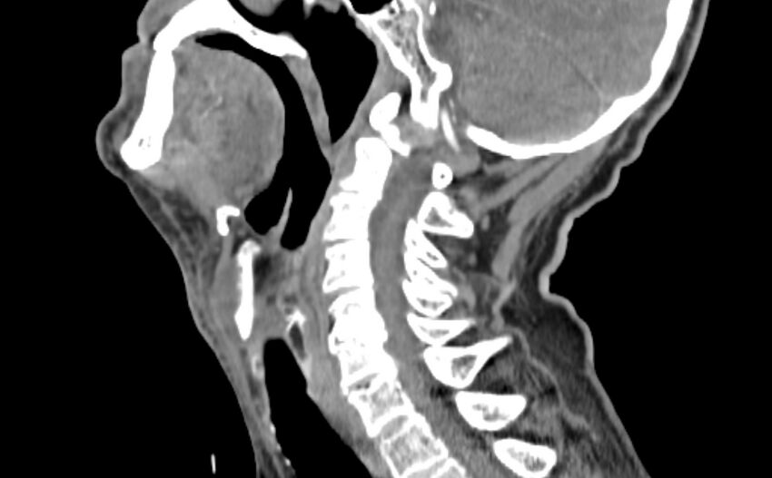 Carotid artery pseudoaneurysm (Radiopaedia 84030-99259 E 2).jpg