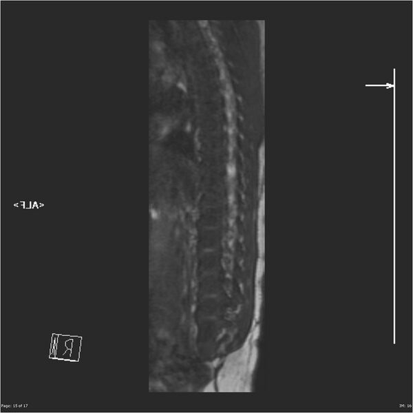 File:Caudal regression syndrome (Radiopaedia 23610-23727 Sagittal CISS 15).jpg