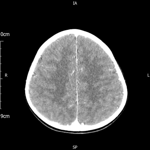 File:Cavernous sinus thrombosis (Radiopaedia 79414-92510 Axial Brain 140).jpg