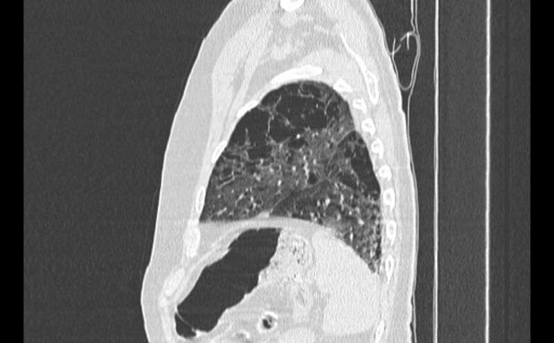 File:Cavitating bronchogenic carcinoma (Radiopaedia 44489-48162 Sagittal lung window 58).jpg