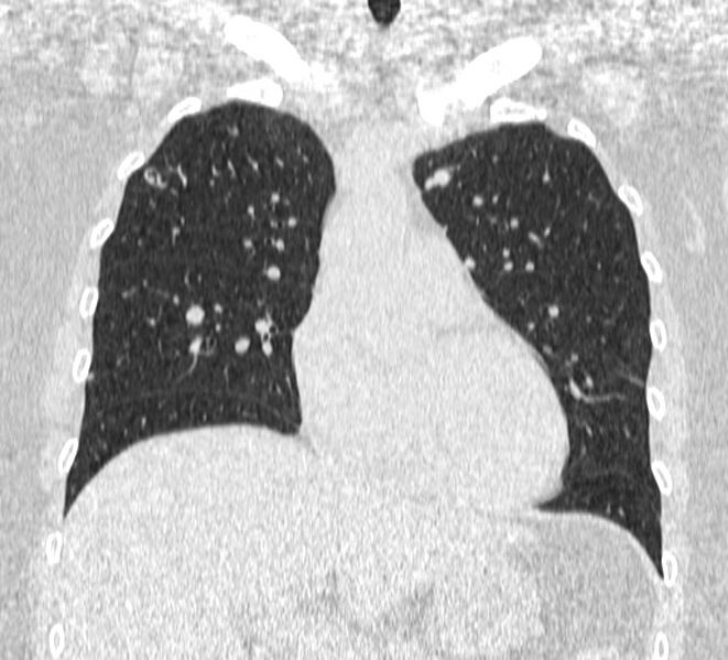 File:Cavitating pulmonary metastases (Radiopaedia 17796-17555 Coronal lung window 7).jpg