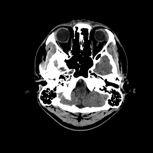 File:Central neurocytoma (Radiopaedia 79320-92379 Axial non-contrast 8).jpg
