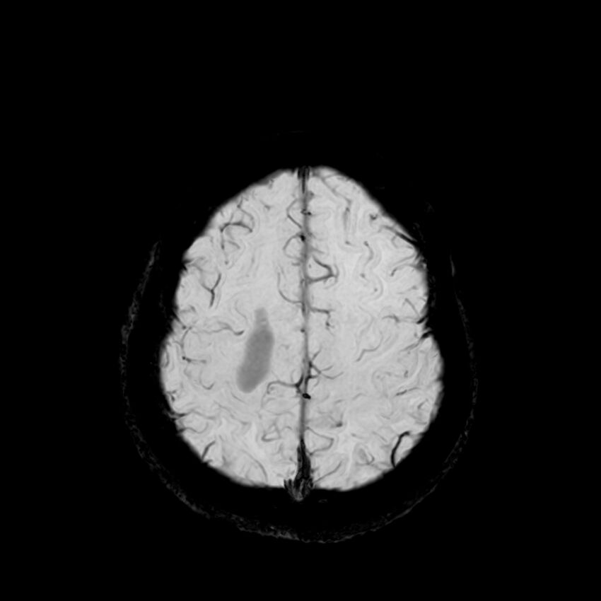 Central neurocytoma (Radiopaedia 79320-92380 Axial SWI 114).jpg