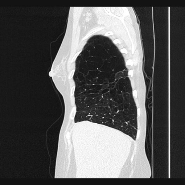 File:Centrilobular pulmonary emphysema (Radiopaedia 24495-24789 Sagittal lung window 12).jpg