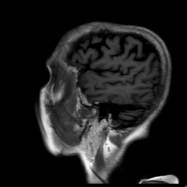 File:Cerebellar ataxia with neuropathy and vestibular areflexia syndrome (CANVAS) (Radiopaedia 74283-85159 Sagittal FLAIR 18).jpg