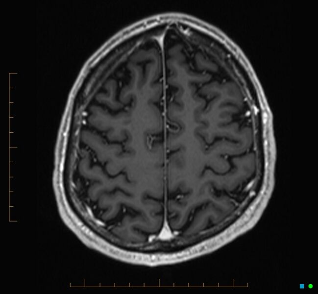 File:Cerebellar gangliocytoma (Radiopaedia 65377-74422 Axial T1 C+ 112).jpg