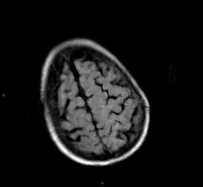 File:Cerebral amyloid angiopathy-associated lobar intracerebral hemorrhage (Radiopaedia 58377-65515 Axial FLAIR 6).jpg