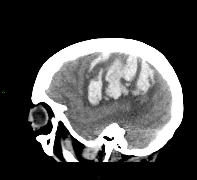 File:Cerebral amyloid angiopathy-associated lobar intracerebral hemorrhage (Radiopaedia 58379-65519 C 14).jpg