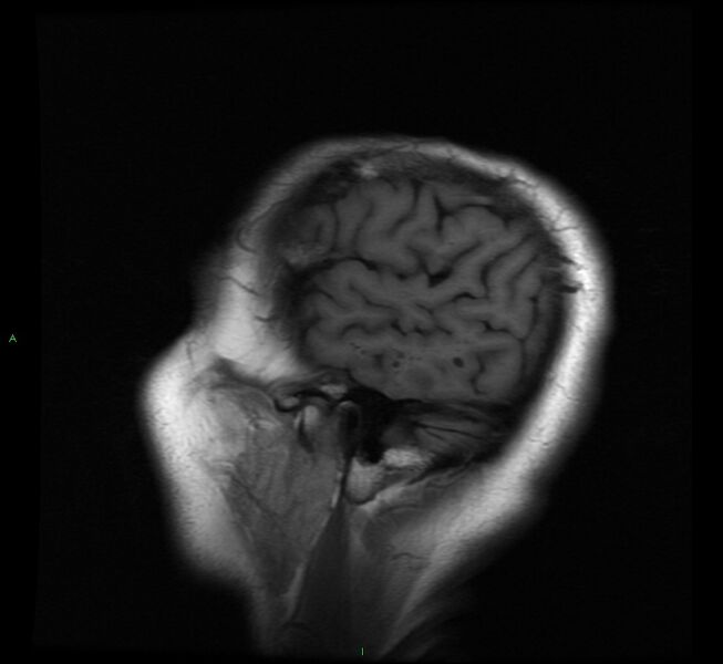 File:Cerebral amyloid angiopathy-associated lobar intracerebral hemorrhage (Radiopaedia 58529-65684 Sagittal T1 3).jpg