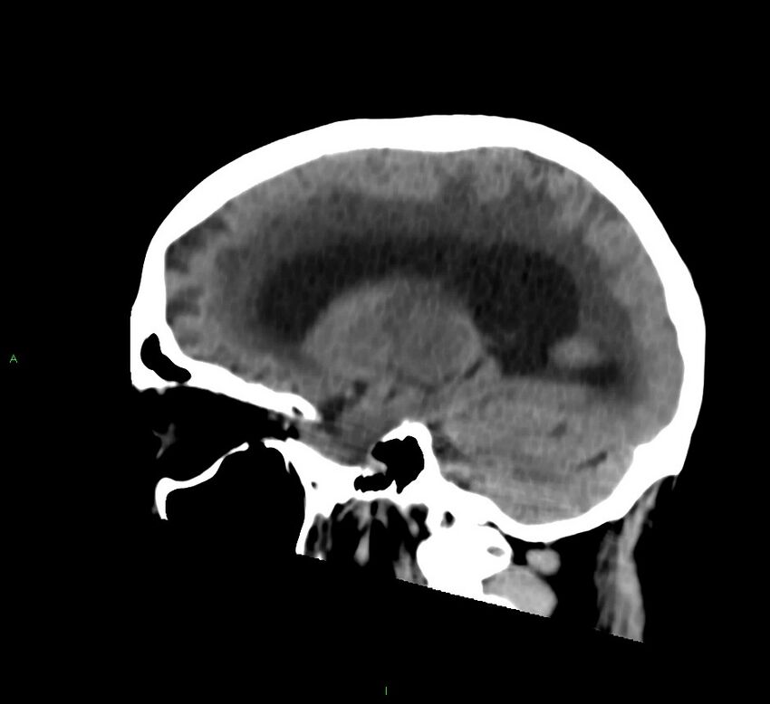 Cerebral amyloid angiopathy-associated lobar intracerebral hemorrhage (Radiopaedia 58530-65688 C 20).jpg
