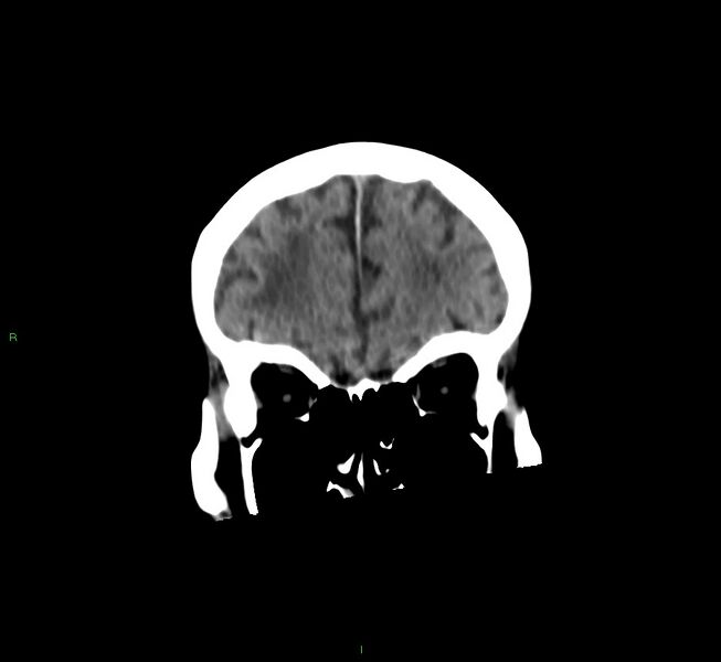 File:Cerebral amyloid angiopathy-associated lobar intracerebral hemorrhage (Radiopaedia 58530-65688 Coronal non-contrast 53).jpg