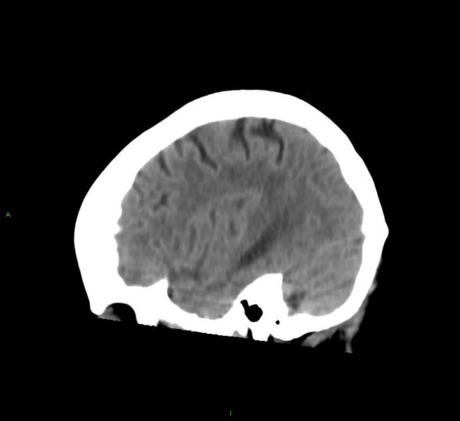 File:Cerebral amyloid angiopathy-associated lobar intracerebral hemorrhage (Radiopaedia 58754-65975 C 12).jpg