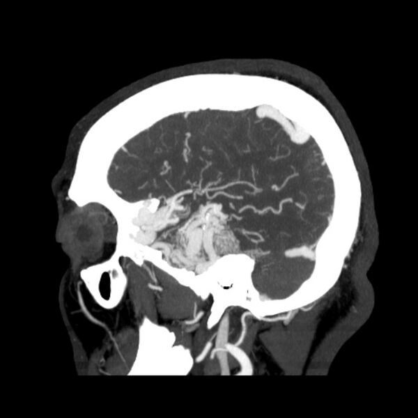 File:Cerebral arteriovenous malformation (Radiopaedia 43729-47189 D 40).jpg